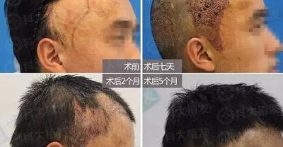 种植牙真的有那么好吗？