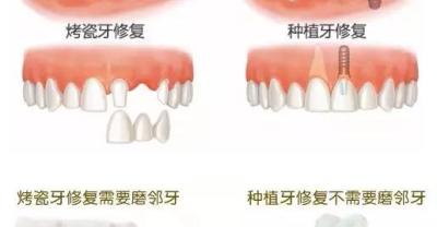 做完种植牙需要注意什么？