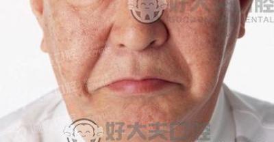 当牙缺失遇见牙种植